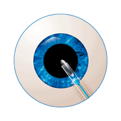 Cataract-Treatment-A
