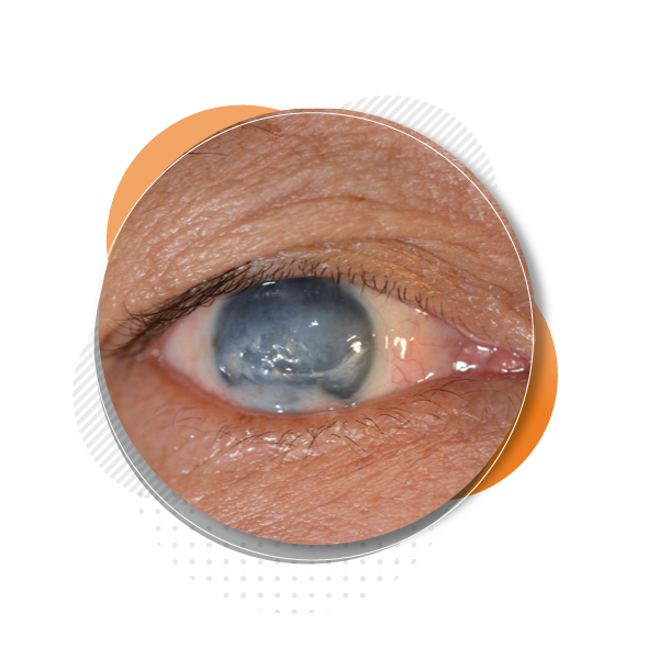 glaucoma-surgery-in-maharashtra