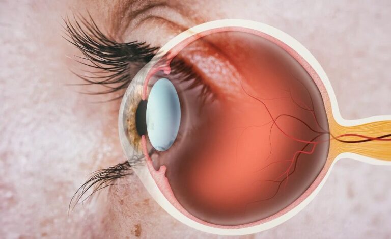 Retina Detached Treatment