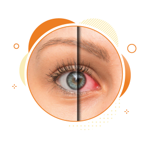 best treatment for dry eye in thane