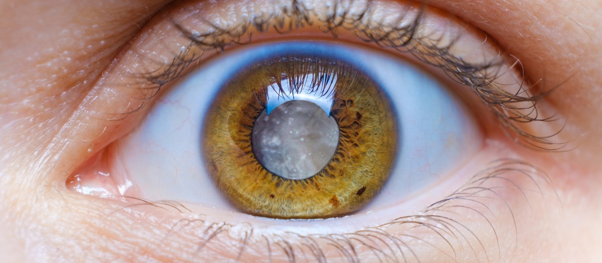 Can You Live Without Cataract Surgery?