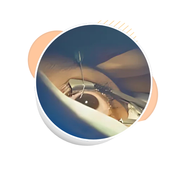 Corneal Transplantation